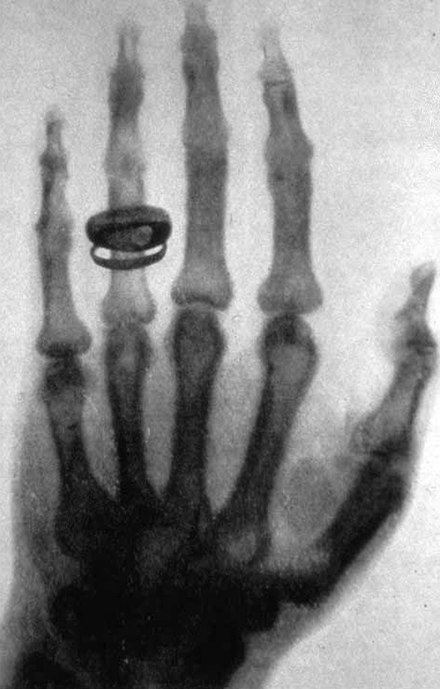 La prima radiografia: la mano di Anna Bertha